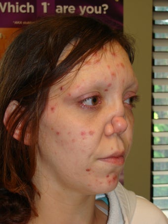 Rhinoplasty 368032