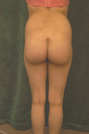 Women's Buttocks Augmentation 518136