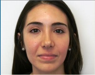 Facial Rejuvenation with Soft tissue fillers before 414179