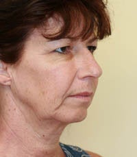Face and Necklift, Eyelids, Temporal Browlift before 232352