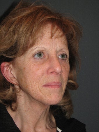 Facelift and Chemical Peel before 123605