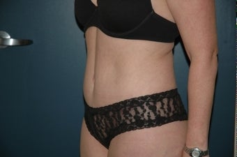 Tummy tuck after 283874