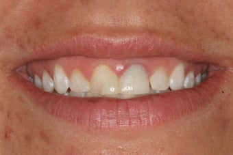 Simple Smile Design with gum lift and porcelain veneers before 92911