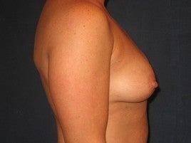 Breast Augmentation 555989
