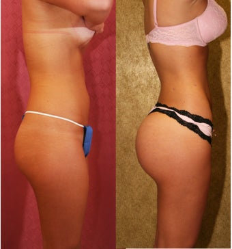 Brazilian Butt Lift 637891