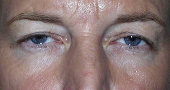 Upper Lid Blepharoplasty before 147715