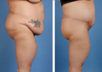Lower Body Lift and Extended Tummy Tuck 335991