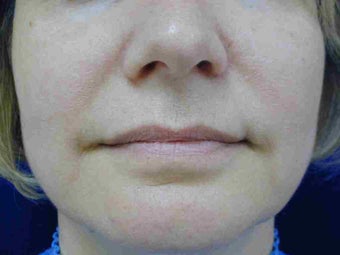 Radiesse treatment before 108821