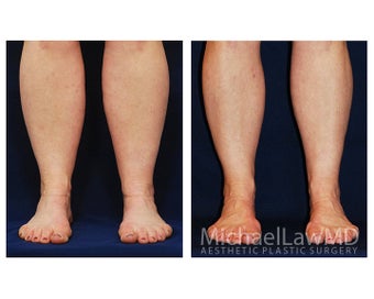 Liposuction before 499133