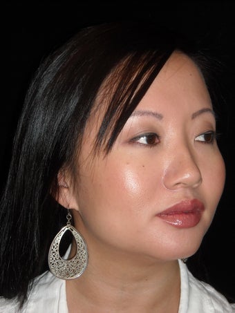 Lip augmentation with Juvederm after 234097