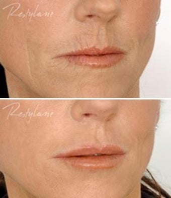 Restylane Lip Definition Before After before 6283