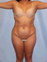 Tummy Tuck Surgery (abdominoplasty) before 139139