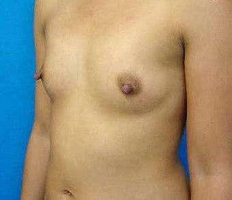 Breast Augmentation 317789