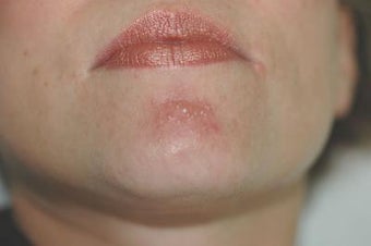 Laser Acne Treatment before 82958