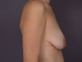 Breast Lift / Breast Augmentation before 291040