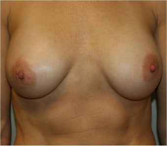 Breast Augmentation after 110453
