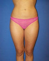 Liposuction of the abdomen, flanks and lateral thighs after 130049