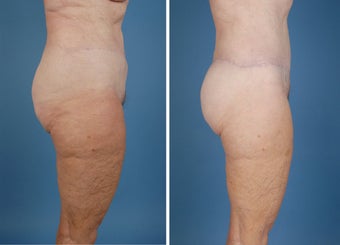 Flank Excision, Abdominoplasty Scar Revision, Liposuction of the Back 303691