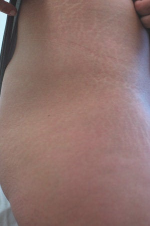 Laser for Stretch Marks before 199402