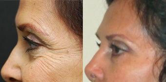 Crows Feet before 549866