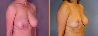 Breast Reduction before 271111