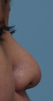 Non Surgical Rhinoplasty before 328327