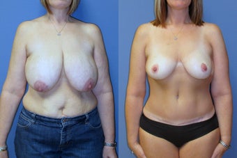 breast reduction and abdominoplasty before 579282