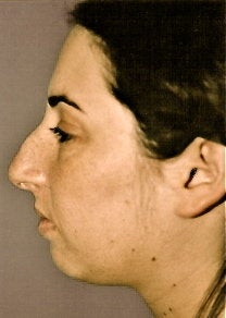 Rhinoplasty before 278373
