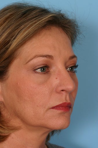 Brow Lift, Blepharoplasty, and Fat Transfer after 86378