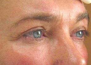 Ultherapy before 520618