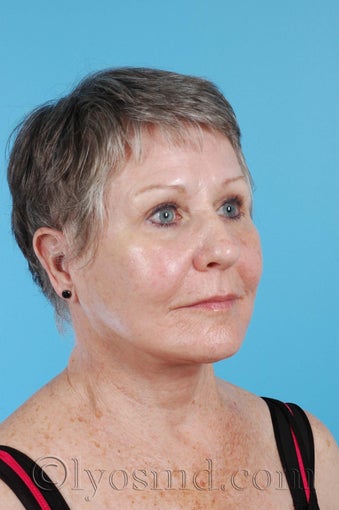 Limited Incision Facelift, Upper and Lower Blepharoplasty after 255909
