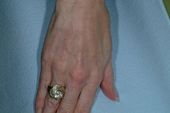 Sclreotherapy for the hands after 92032