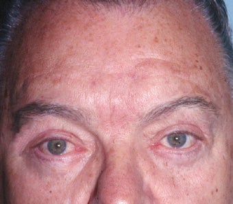 Blepharoplasty after 322229