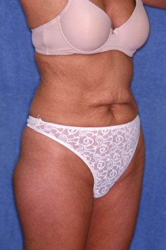 Tummy Tuck with Liposuction 411589
