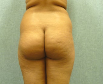 Brazilian Butt Lift 392905