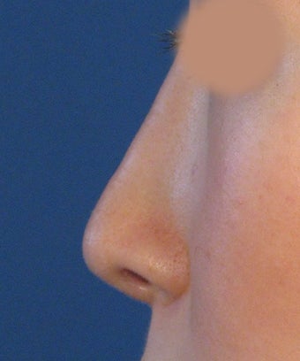 Revision Rhinoplasty 410604