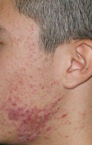 Fraxel Repair for Acne before 374243