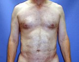 Male Liposuction of the back and abdomen after 125015