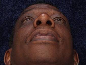 Rhinoplasty 396370