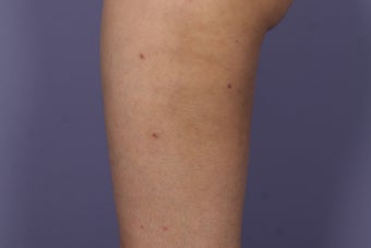 Cellulaze after 576600