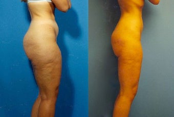 Liposuction before 636185