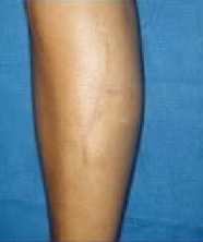 Scar revision of leg after 316562