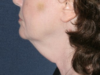 Liposculpture 486632