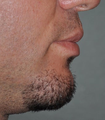 Chin Augmentation 521701