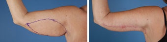 Arm Lift (Brachioplasty) after 303695
