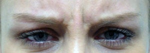 BOTOX Cosmetic before 566677