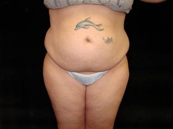 Liposuction of Abdomen, Waist, Flanks and Dorsal Roll before 203473