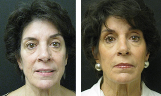 Liquid Facelift - fillers before 603989