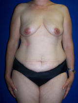 Extended Tummy Tuck (abdominoplasty) and Saline Implants before 128665