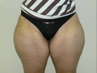 Inner thigh lift before 234247